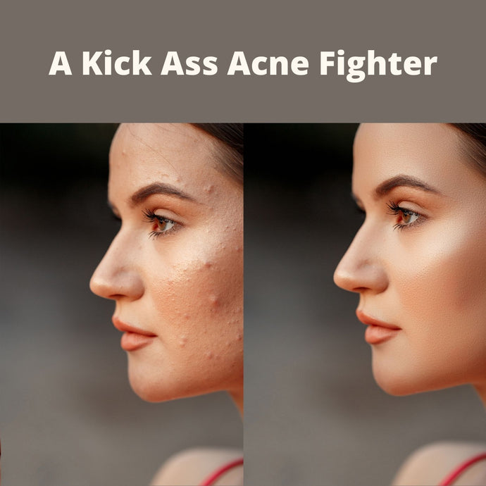 Benzoyl Peroxide & Oil Cleanser Together, A New Kick-Ass Acne Fighter